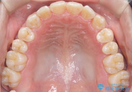 八重歯のデコボコを、目立たない矯正で解消の治療後