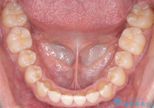 八重歯のデコボコを、目立たない矯正で解消の治療後