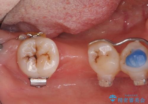 歯周病治療、部分矯正、インプラントを組み合わせた奥歯の治療の治療中