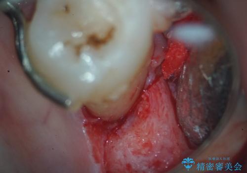 歯周病治療、部分矯正、インプラントを組み合わせた奥歯の治療