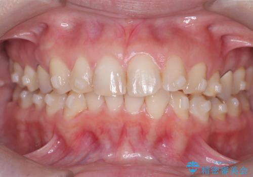 下の前歯のデコボコを、目立たない矯正ですっきりとの治療中