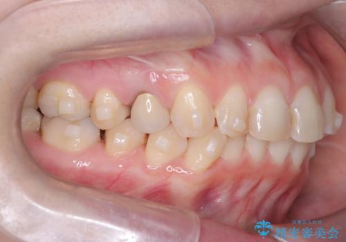 下の前歯のデコボコを、目立たない矯正ですっきりとの治療中