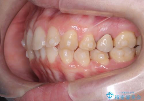 下の前歯のデコボコを、目立たない矯正ですっきりとの治療中