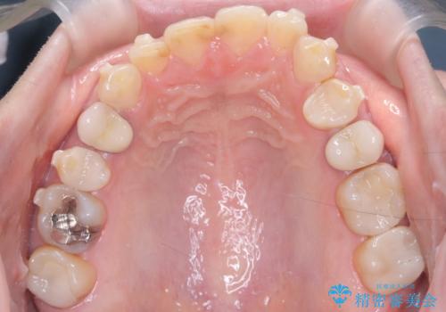 下の前歯のデコボコを、目立たない矯正ですっきりとの治療中