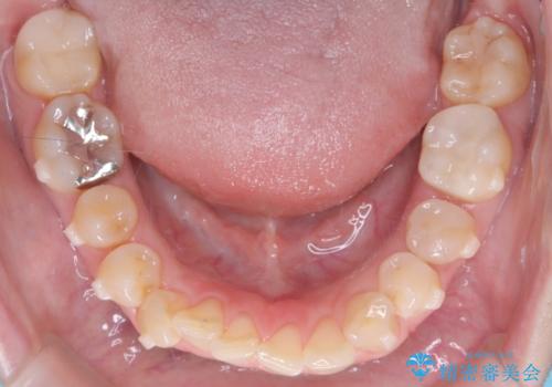下の前歯のデコボコを、目立たない矯正ですっきりとの治療中