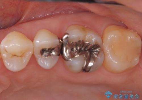 奥歯の銀歯を自然なセラミックに。安心のメタルフリー治療の症例 治療前