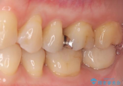 奥歯の銀歯を自然なセラミックに。安心のメタルフリー治療の治療前