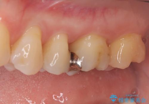 奥歯の銀歯を自然なセラミックに。安心のメタルフリー治療の治療前