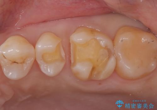 奥歯の銀歯を自然なセラミックに。安心のメタルフリー治療の治療中
