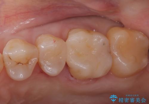 奥歯の銀歯を自然なセラミックに。安心のメタルフリー治療の症例 治療後