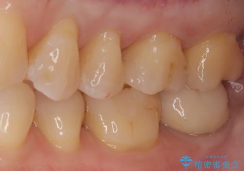 奥歯の銀歯を自然なセラミックに。安心のメタルフリー治療の治療後