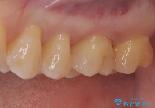 奥歯の銀歯を自然なセラミックに。安心のメタルフリー治療の治療後