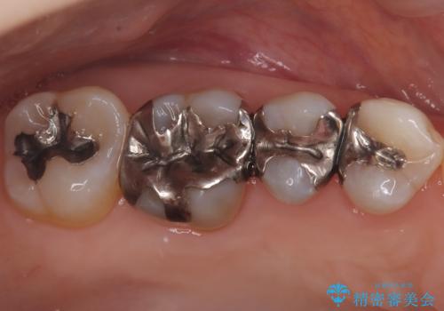 奥歯の銀歯を自然なセラミックに。安心のメタルフリー治療の治療前