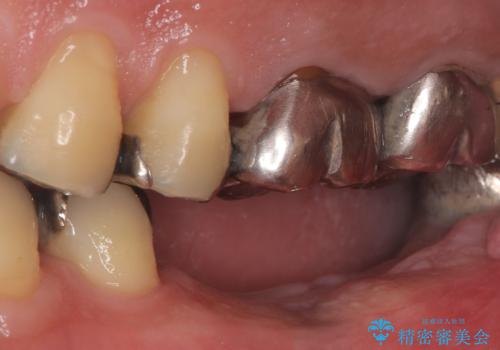 合わない入れ歯から卒業!奥歯2本をインプラントで快適にの治療前