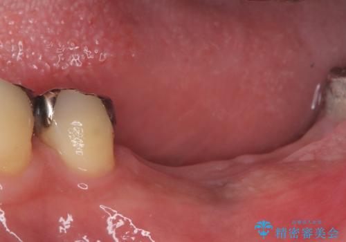 合わない入れ歯から卒業!奥歯2本をインプラントで快適にの治療前