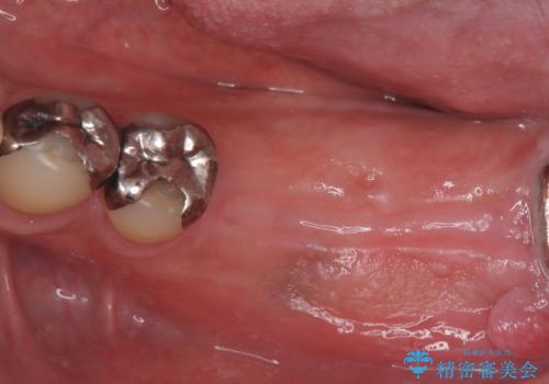 合わない入れ歯から卒業!奥歯2本をインプラントで快適にの治療前