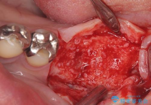 合わない入れ歯から卒業!奥歯2本をインプラントで快適にの治療中
