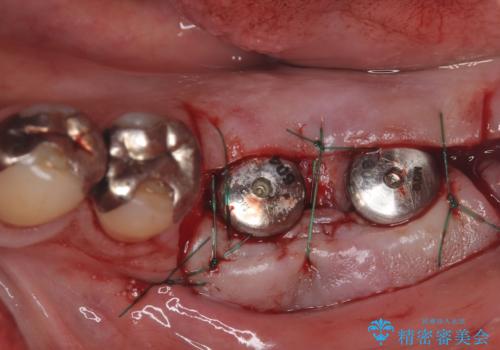 合わない入れ歯から卒業!奥歯2本をインプラントで快適にの治療中
