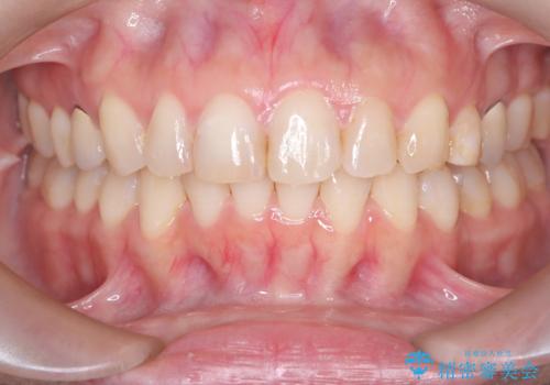 下の前歯のデコボコを、目立たない矯正ですっきりとの治療後