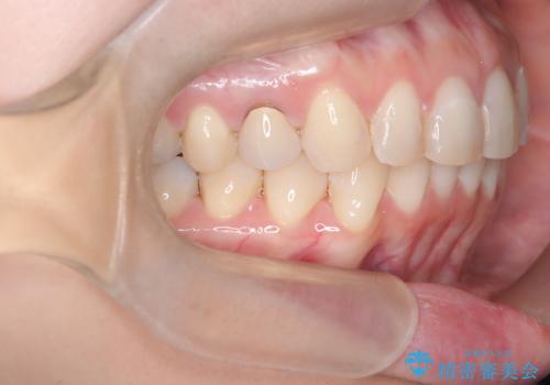 下の前歯のデコボコを、目立たない矯正ですっきりとの治療後