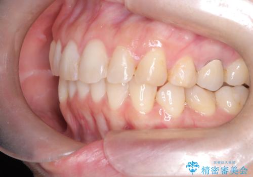 下の前歯のデコボコを、目立たない矯正ですっきりとの治療後