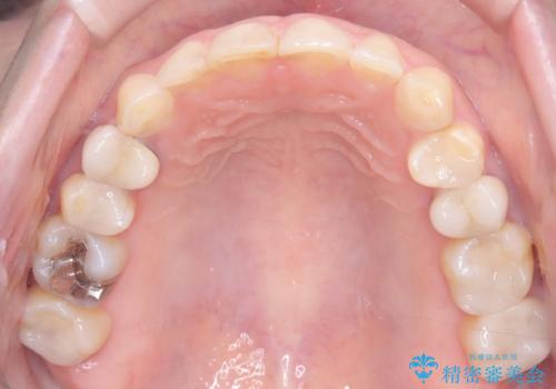 下の前歯のデコボコを、目立たない矯正ですっきりとの治療後