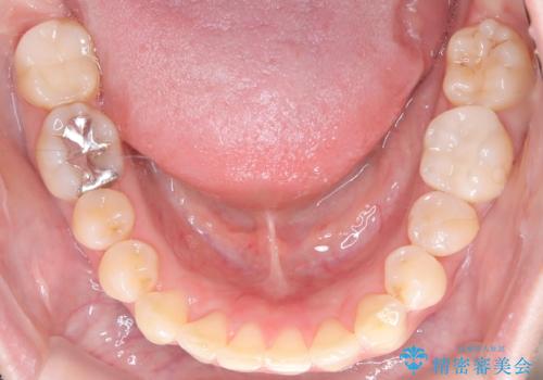下の前歯のデコボコを、目立たない矯正ですっきりとの治療後