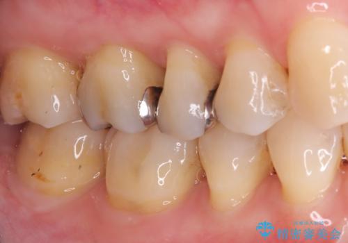 奥歯の銀歯を自然なセラミックに。安心のメタルフリー治療の治療前
