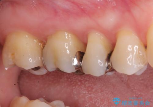 奥歯の銀歯を自然なセラミックに。安心のメタルフリー治療の治療前