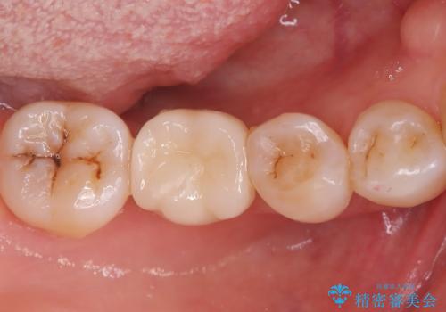歯周病治療、部分矯正、インプラントを組み合わせた奥歯の治療の症例 治療後