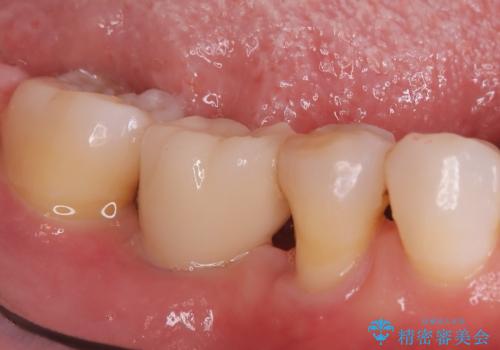 歯周病治療、部分矯正、インプラントを組み合わせた奥歯の治療の治療後