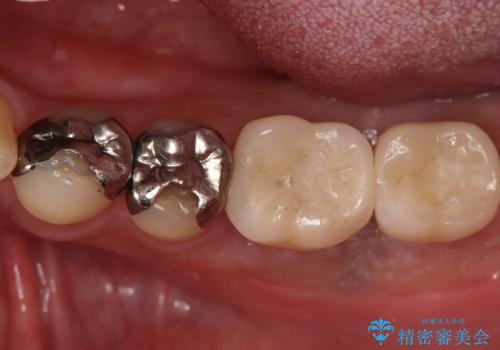 合わない入れ歯から卒業!奥歯2本をインプラントで快適にの治療後