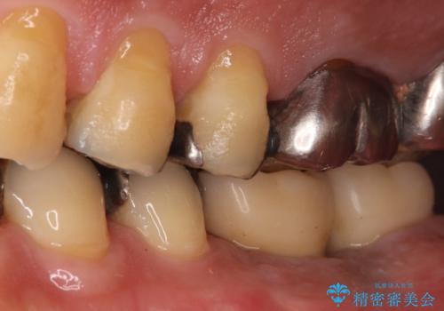 合わない入れ歯から卒業!奥歯2本をインプラントで快適にの治療後