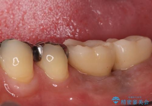 合わない入れ歯から卒業!奥歯2本をインプラントで快適に