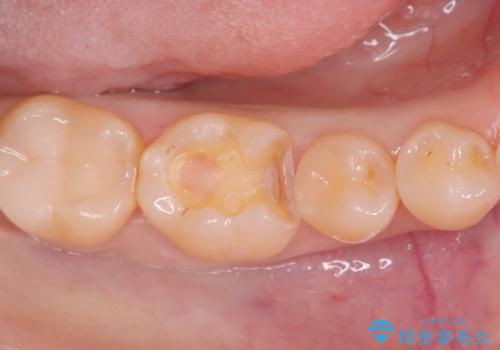 奥歯の銀歯を自然に!右下6番のメタルフリー治療の治療中