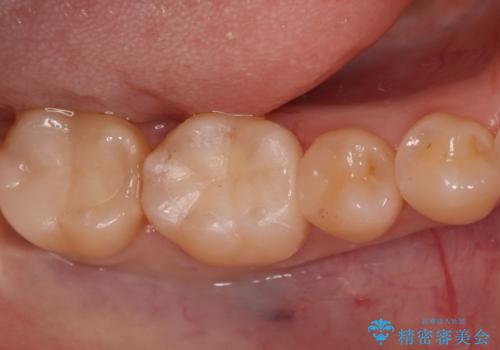 奥歯の銀歯を自然に!右下6番のメタルフリー治療