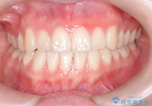 八重歯と前歯の逆の咬み合わせを、目立たない矯正で同時に改善の症例 治療後