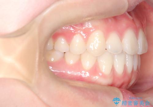 八重歯と前歯の逆の咬み合わせを、目立たない矯正で同時に改善の治療後