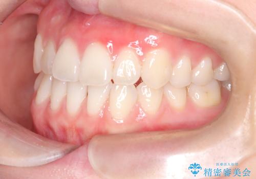 八重歯と前歯の逆の咬み合わせを、目立たない矯正で同時に改善の治療後