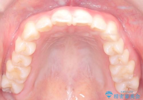 八重歯と前歯の逆の咬み合わせを、目立たない矯正で同時に改善の治療後