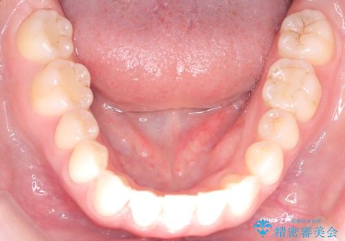 八重歯と前歯の逆の咬み合わせを、目立たない矯正で同時に改善の治療後