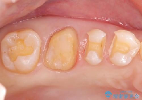 奥歯の銀歯を自然なセラミックに。安心のメタルフリー治療の治療中