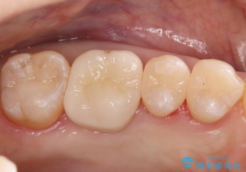 奥歯の銀歯を自然なセラミックに。安心のメタルフリー治療の治療後