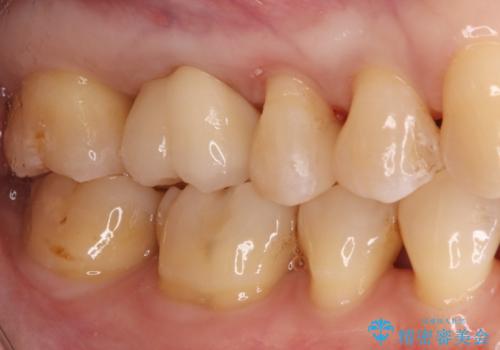 奥歯の銀歯を自然なセラミックに。安心のメタルフリー治療の治療後