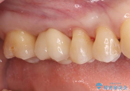 奥歯の銀歯を自然なセラミックに。安心のメタルフリー治療の治療後