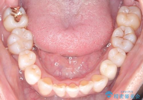 50代からの矯正治療!ブリッジを活かし八重歯を解消の治療後