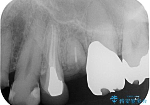 外科処置は一度だけ|抜歯即時インプラントで短期間で自然な見た目への治療前