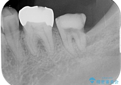 抜歯即時インプラントで治療期間を大幅短縮!抜歯からセラミックまでを3か月で完了の治療前