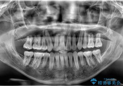 【モニター】前歯のデコボコと口元の出っ張りを改善!目立たない矯正で自然な笑顔にの治療後