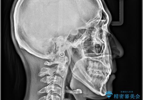 【モニター】前歯のデコボコと口元の出っ張りを改善!目立たない矯正で自然な笑顔にの治療後